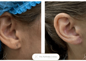 Lobuloplastia Dra Katherine Estevez