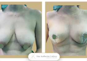 Matopexia Dra Katherine Estévez