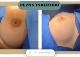 Pezón Invertido Dra Katherine Estévez