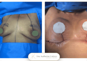Reducción Mamaria sin Implantes Dra Katherine Estévez