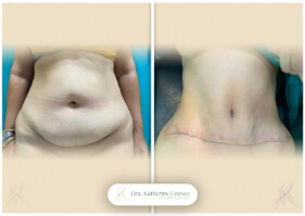 adomnioplastia adomnioplastia