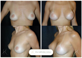 aumento de mamas aumento de mamas