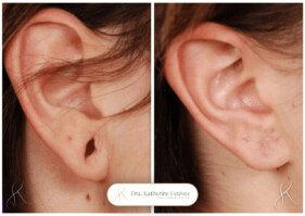 lobuloplastia lobuloplastia