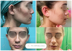 otoplastia otoplastia