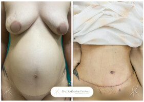 adomnioplastia adomnioplastia