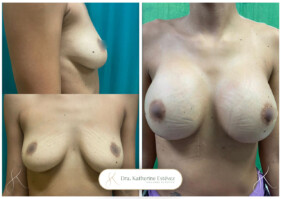 aumento de mamas aumento de mamas