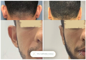 otoplastia otoplastia