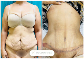 adomnioplastia adomnioplastia