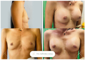 aumento de mamas aumento de mamas