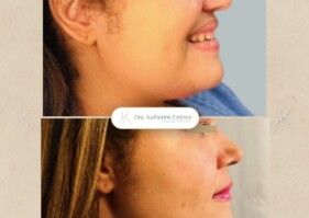 eliminación-papada-enzimatica-Dra-katherine-estevez.j