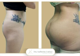 gluteoplastia Dra Katherine Estévez