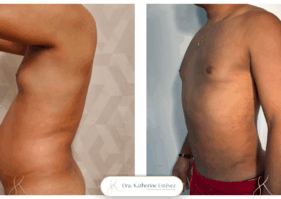 lipoescultura Dra Katherine Estevez