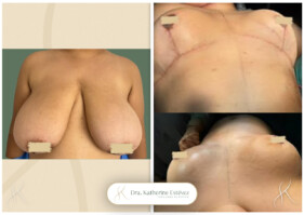 mastoplastia reductora mastoplastia reductora