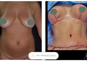 mommy makeover Dra Katherine Estévez