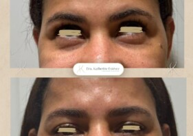 relleno ojeras ácido hialurónico Dra Katherine Estévez